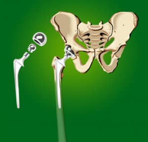 Stryker Hip Implant Lawyers