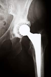 DePuy ASR & Pinnacle Hip Implant Lawyers