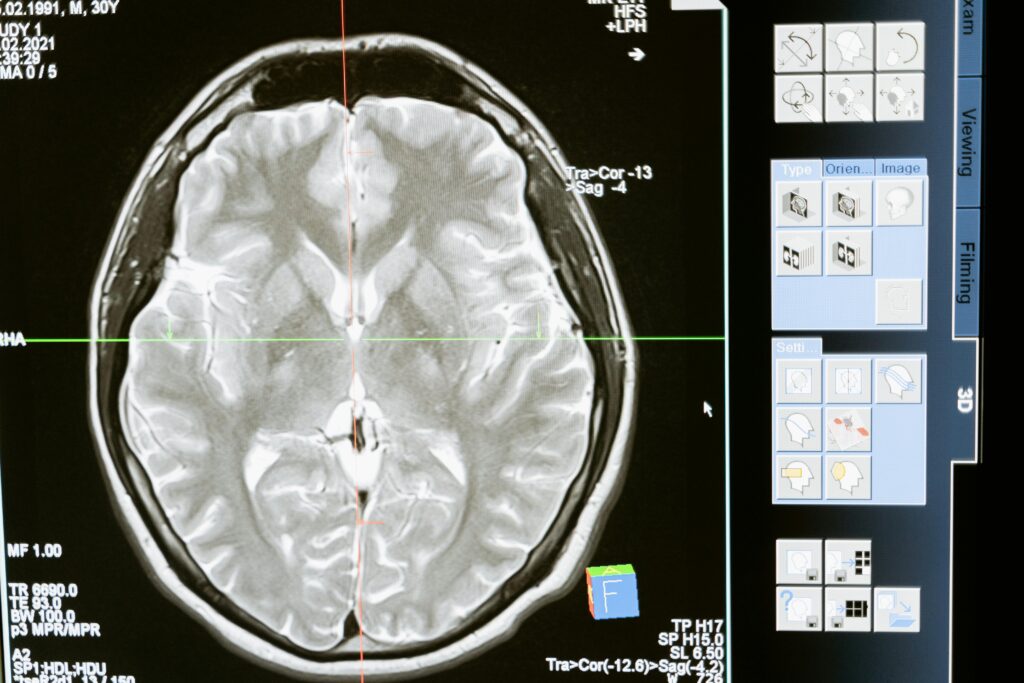 Lesiones Cerebrales Traumáticas